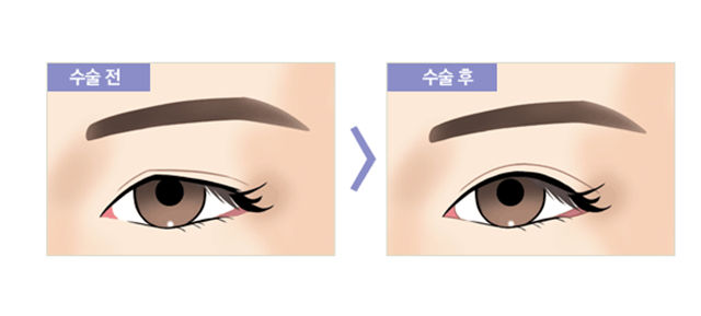 센트럴성형외과 