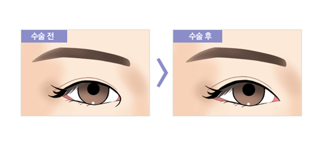 센트럴성형외과 