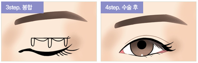 센트럴성형외과 