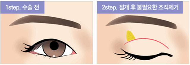 센트럴성형외과 