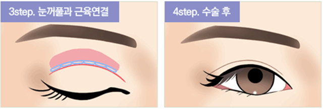 센트럴성형외과 