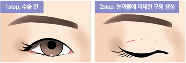 센트럴성형외과 