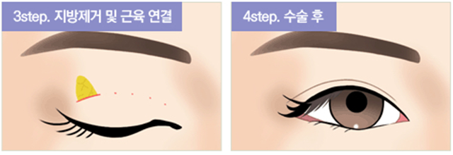 센트럴성형외과 