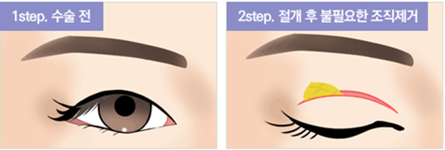 센트럴성형외과 