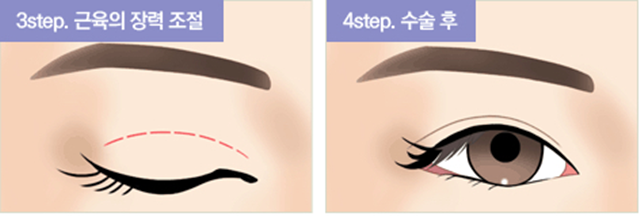 센트럴성형외과 