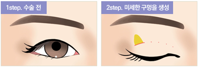센트럴성형외과 