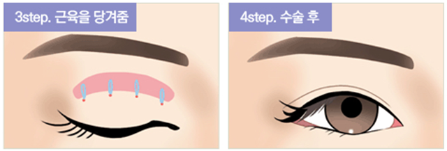 센트럴성형외과 