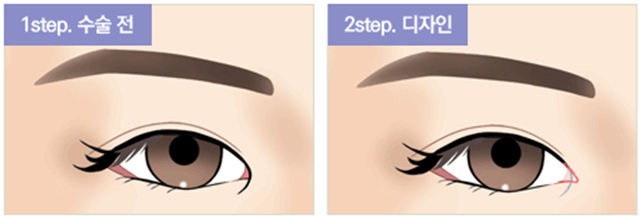 센트럴성형외과 