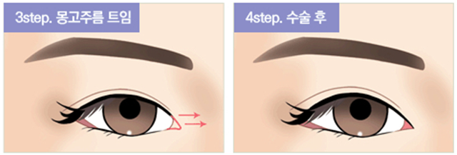 센트럴성형외과 