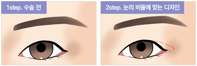 센트럴성형외과 
