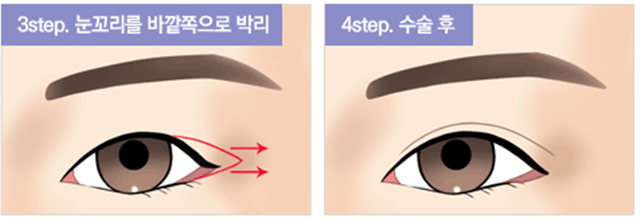 센트럴성형외과 