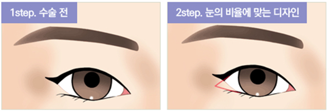 센트럴성형외과 