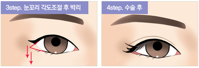 센트럴성형외과 