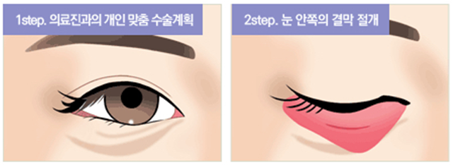 센트럴성형외과 