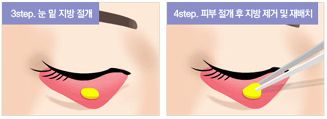 센트럴성형외과 