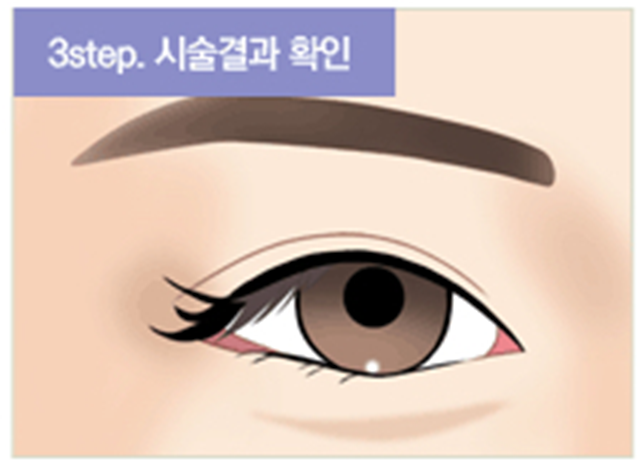 센트럴성형외과 