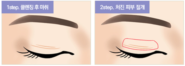 센트럴성형외과 