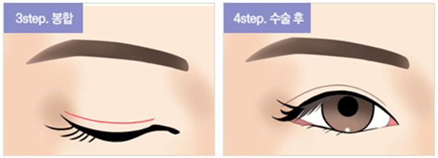 센트럴성형외과 