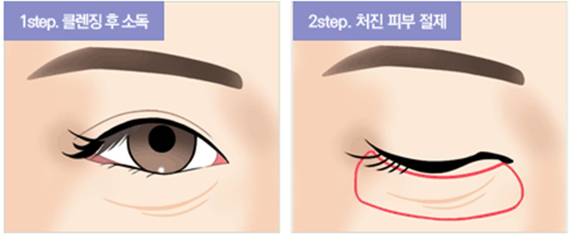 센트럴성형외과 