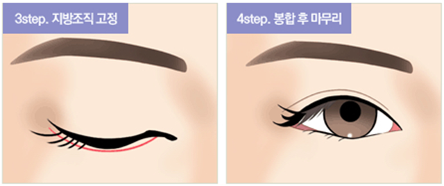 센트럴성형외과 
