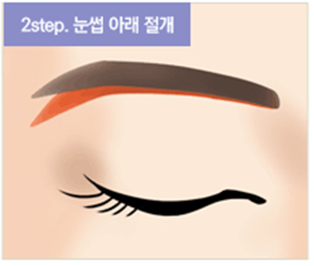 센트럴성형외과 