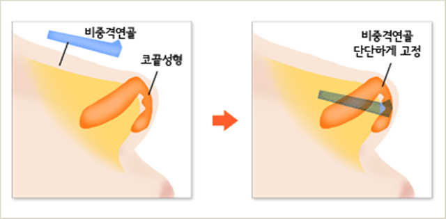 센트럴성형외과 