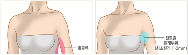 센트럴성형외과 