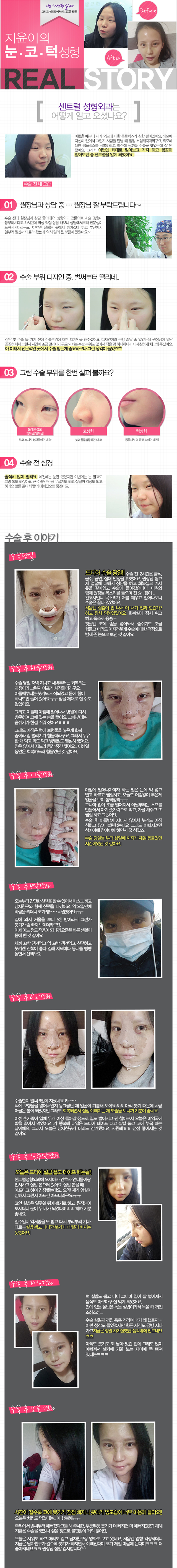 센트럴성형외과 